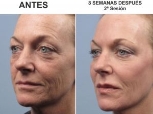 hifu facial resultados