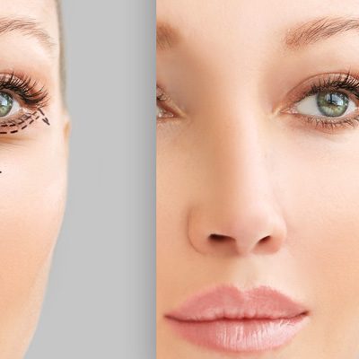 Eliminar la bolsa de los ojos sin cirugía