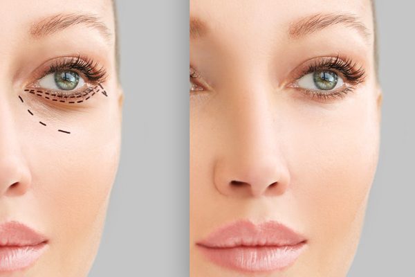 Eliminar la bolsa de los ojos sin cirugía