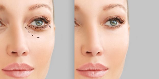 Eliminar la bolsa de los ojos sin cirugía Eliminar la bolsa de los ojos sin cirugía