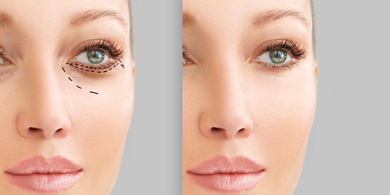 Eliminar la bolsa de los ojos sin cirugía