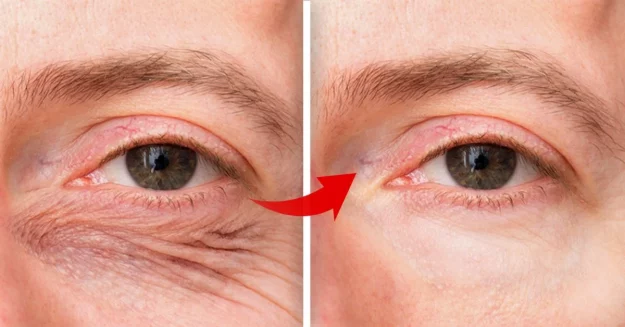 Eliminar arrugas ojos sin cirugía Eliminar arrugas ojos sin cirugía