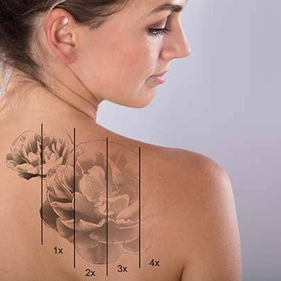 Eliminación de tatuajes con láser guía completa y precios Eliminación de tatuajes con láser guía completa y precios