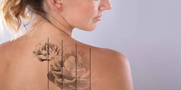 Eliminación de tatuajes con láser guía completa y precios Eliminación de tatuajes con láser guía completa y precios