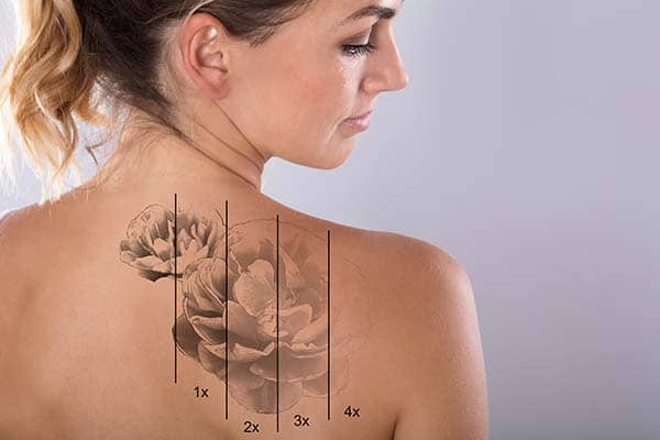 Eliminación de tatuajes con láser guía completa y precios