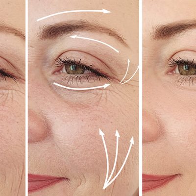 Blefaroplastia sin cirugia antes y después Blefaroplastia sin cirugia antes y después