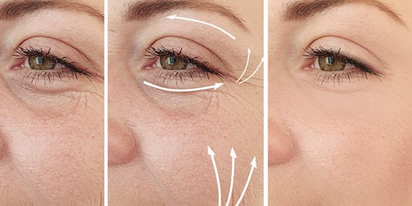 Blefaroplastia sin cirugia antes y después Blefaroplastia sin cirugia antes y después