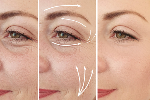 Blefaroplastia sin cirugia antes y después