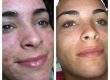 Guía completa sobre Hydra Facial rejuvenecimiento avanzado
