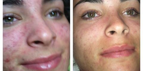 Guía completa sobre Hydra Facial rejuvenecimiento avanzado
