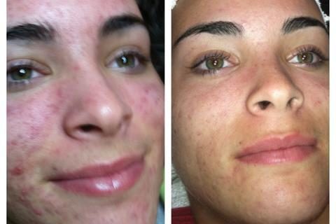 Guía completa sobre Hydra Facial rejuvenecimiento avanzado
