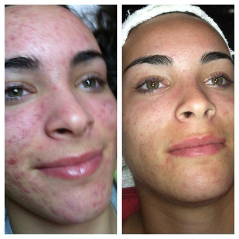 Guía completa sobre Hydra Facial rejuvenecimiento avanzado Guía completa sobre Hydra Facial rejuvenecimiento avanzado