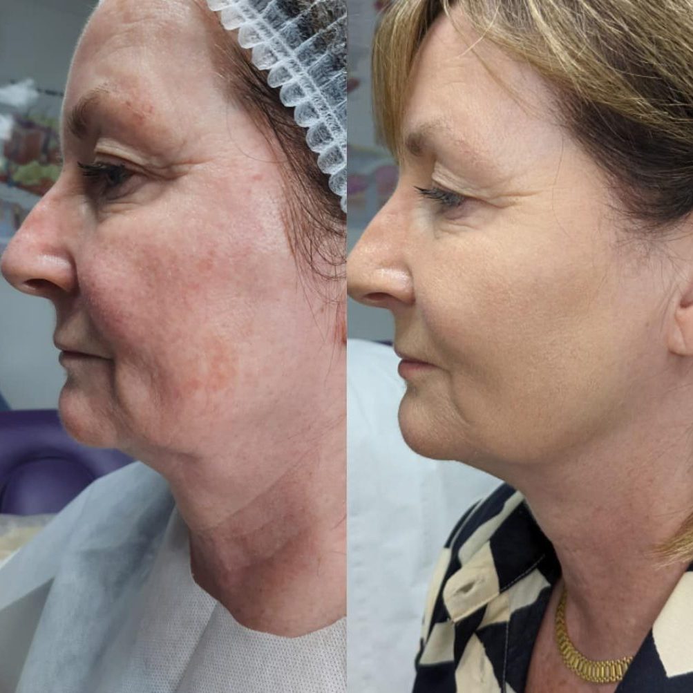 Estimuladores de colágeno: Tecnologías No Invasivas