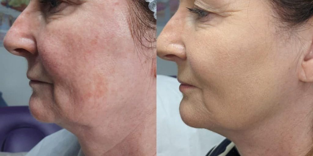 Estimuladores de colágeno: Tecnologías No Invasivas