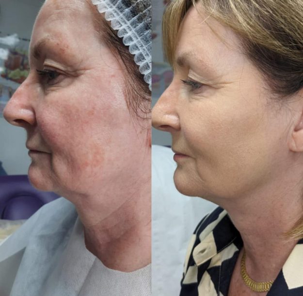 Estimuladores de colágeno: Tecnologías No Invasivas