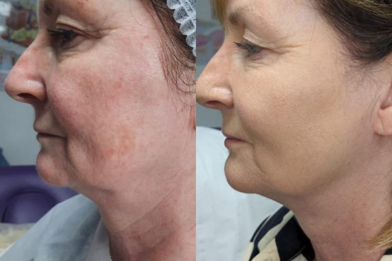 Estimuladores de colágeno: Tecnologías No Invasivas