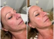 radiofrecuencia facial y corporal las mejores máquinas