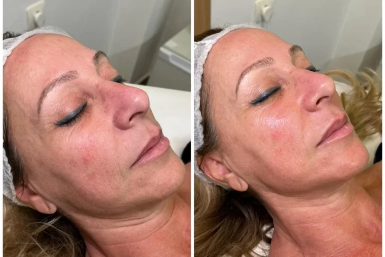radiofrecuencia facial y corporal las mejores máquinas