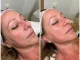 radiofrecuencia facial y corporal las mejores máquinas