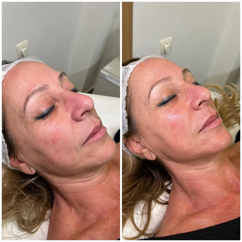 radiofrecuencia facial y corporal las mejores máquinas